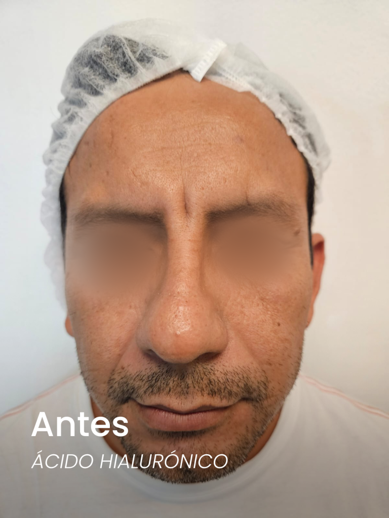 3antes