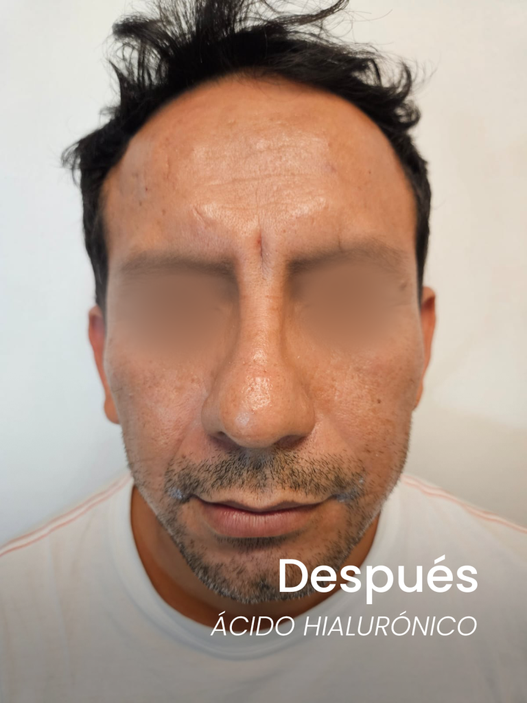 3despues