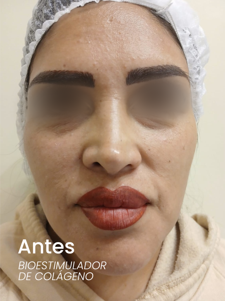 4antes