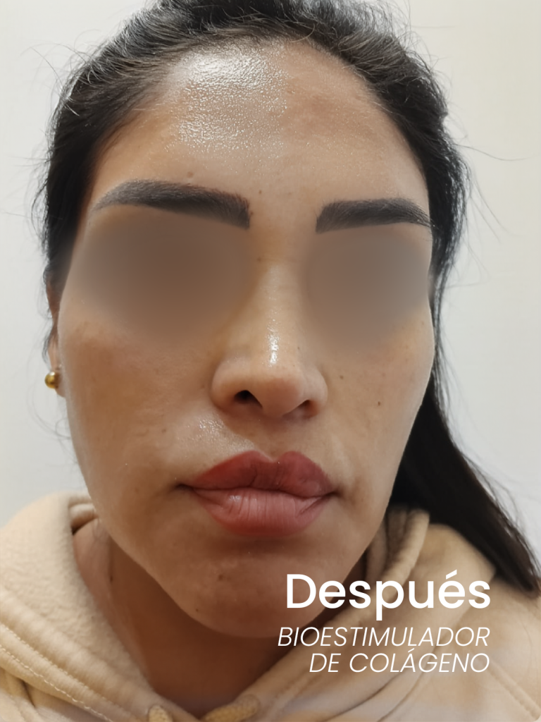 4despues