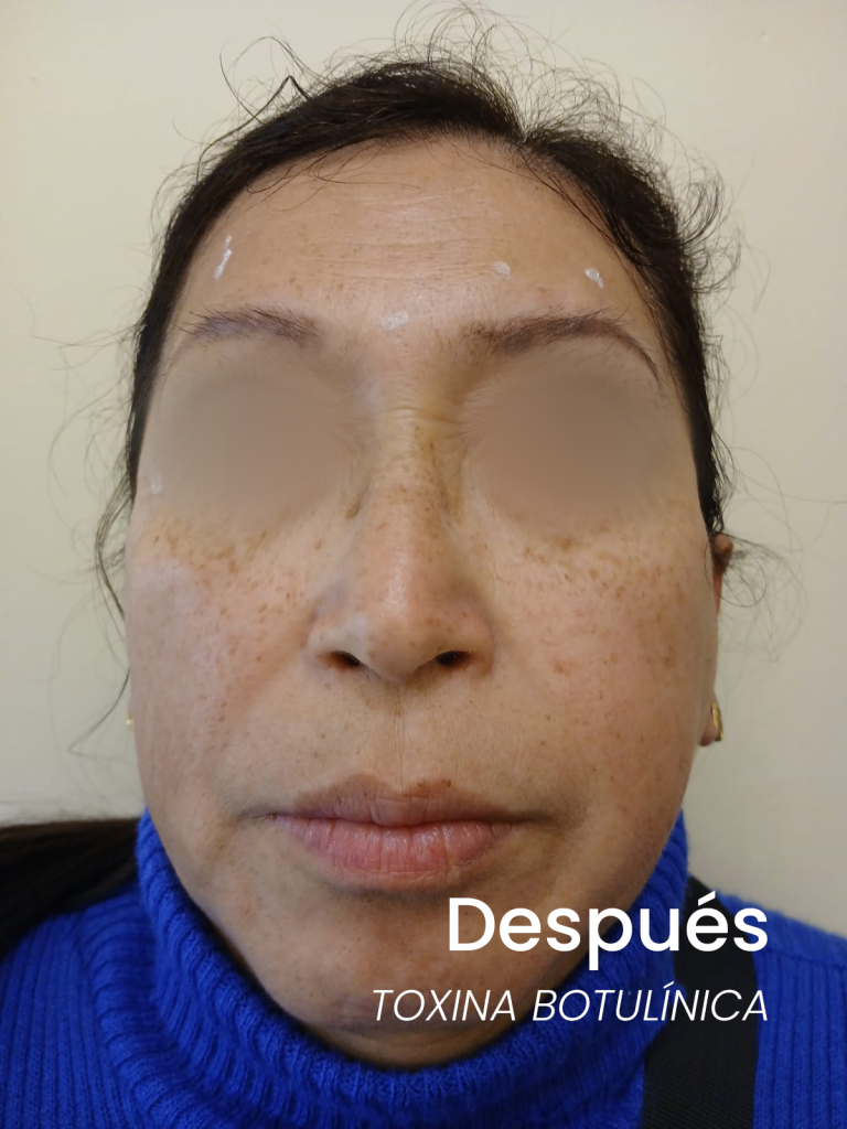 5despues