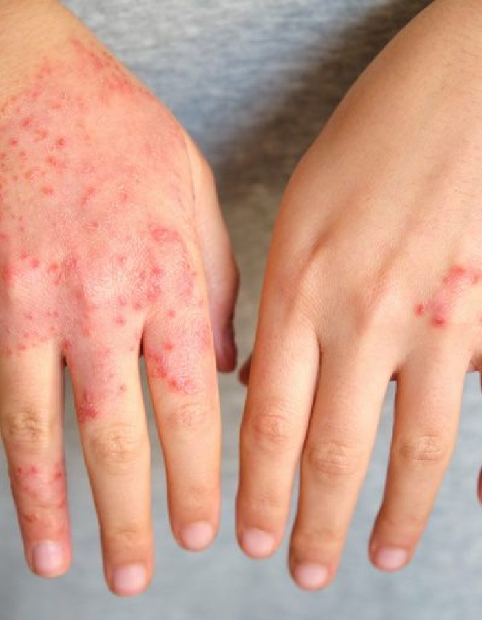 dermatitis